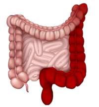 Darm mit Colitus ulcerosa Colitus ulcerosa ist eine Entzündung der oberen Darmschleimhaut . © bilderzwerg - fotolia.com