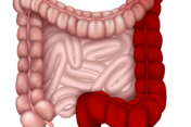 Colitus ulcerosa ist eine Entzündung der oberen Darmschleimhaut .